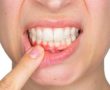 Kadınlar dikkat! Menapoz döneminde diş kaybı yaşayabilirsiniz