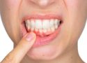 Kadınlar dikkat! Menapoz döneminde diş kaybı yaşayabilirsiniz