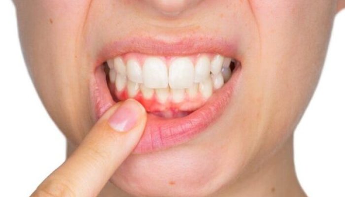 Kadınlar dikkat! Menapoz döneminde diş kaybı yaşayabilirsiniz