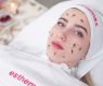 Kimyasal peeling sonrası bakım nasıl yapılır? Adım Adım Rehber